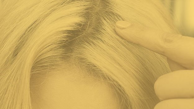 Thinning Hair